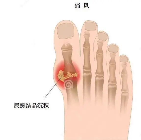 痛风为什么偏爱男性？你最关心的问题都在这里